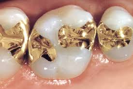 Pure Gold Tooth Filling Procedure