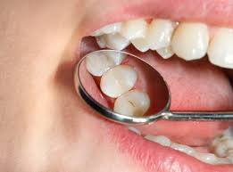 Tooth Decay Treatment
