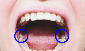 Wisdom Teeth Treatment